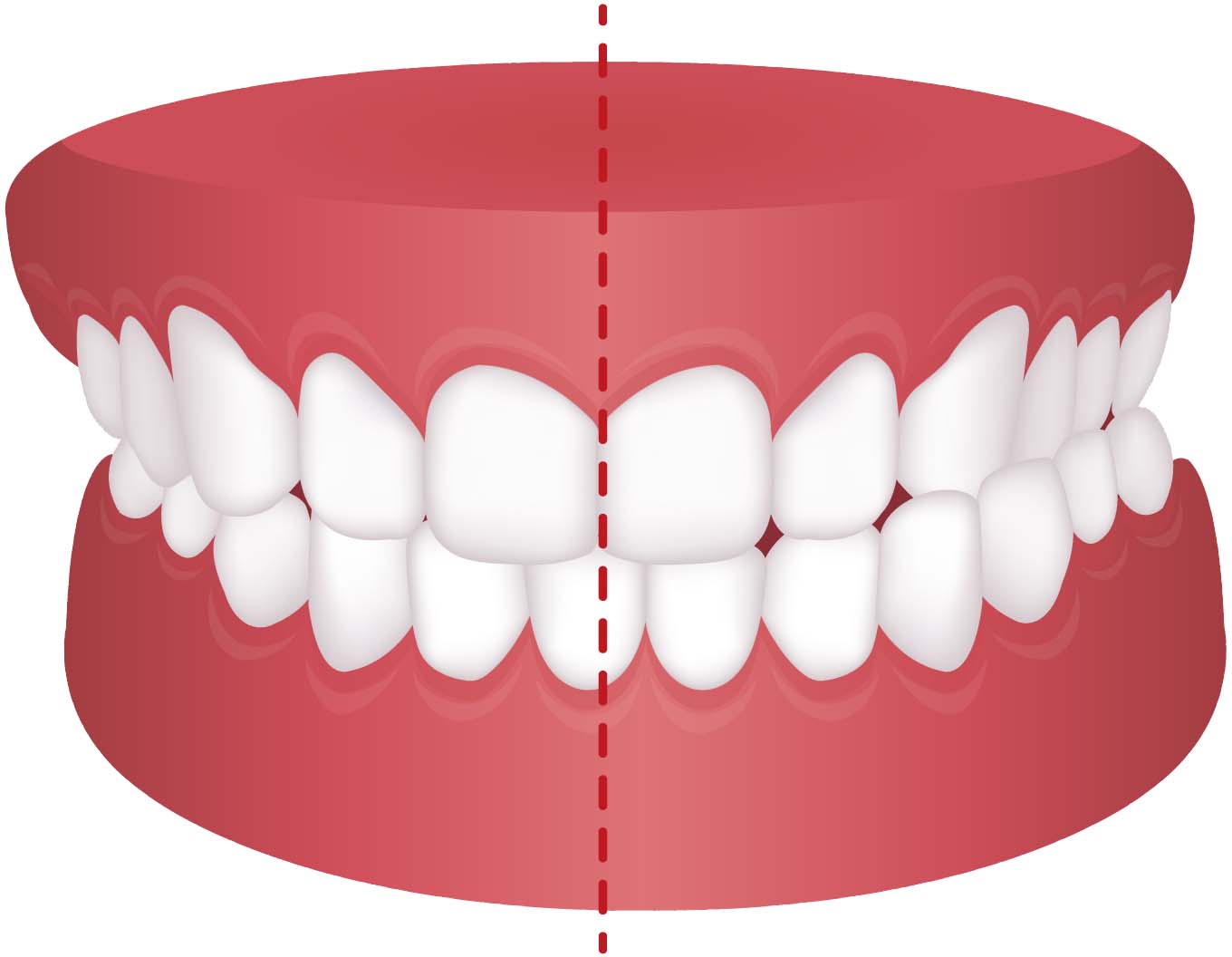 Crossbite